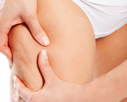 cellulite